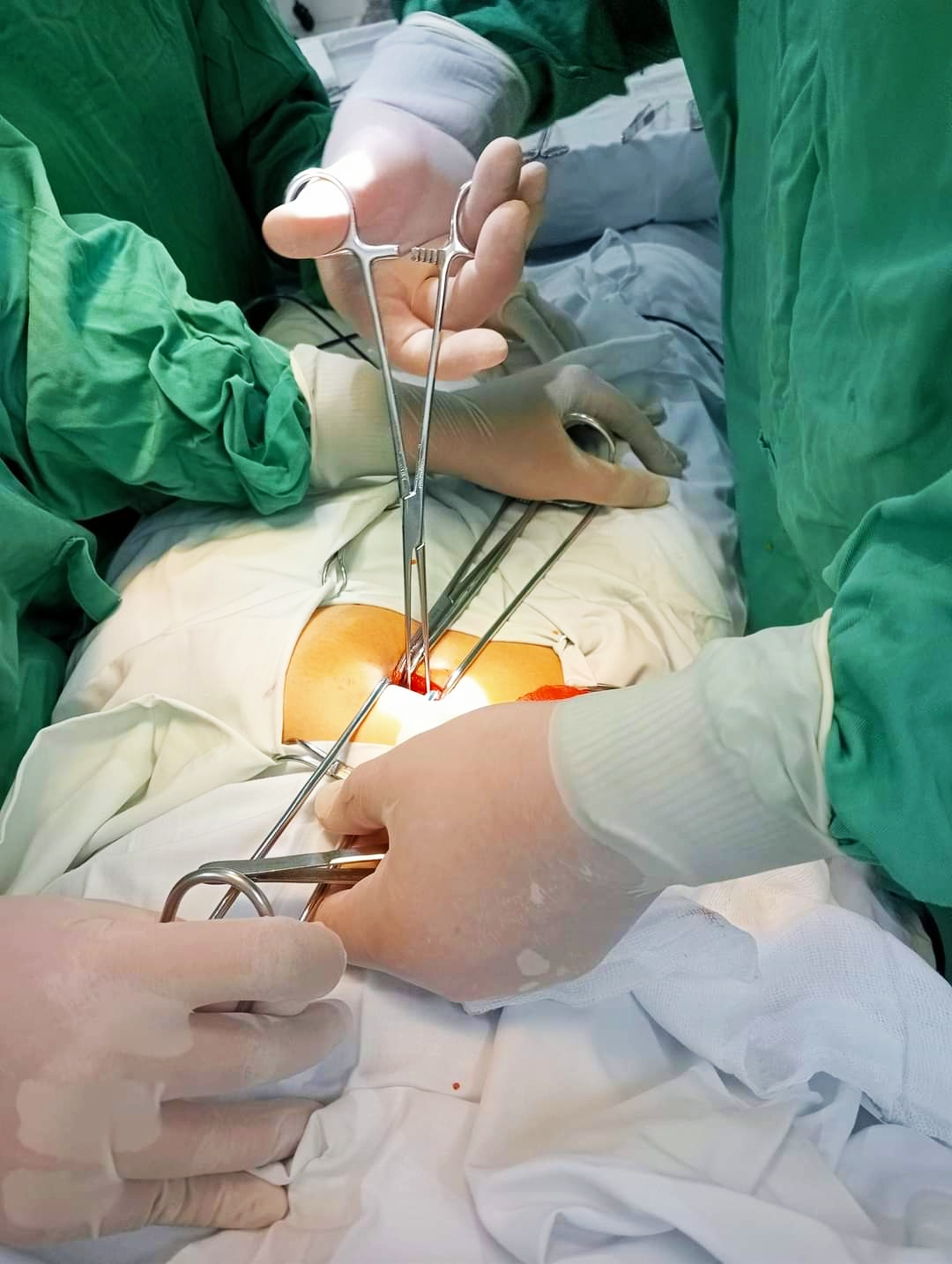  PHẪU THUẬT CẤP CỨU THÀNH CÔNG BỆNH NHÂN  VIÊM RUỘT THỪA CÓ VIÊM TÚI THỪA MECKEL