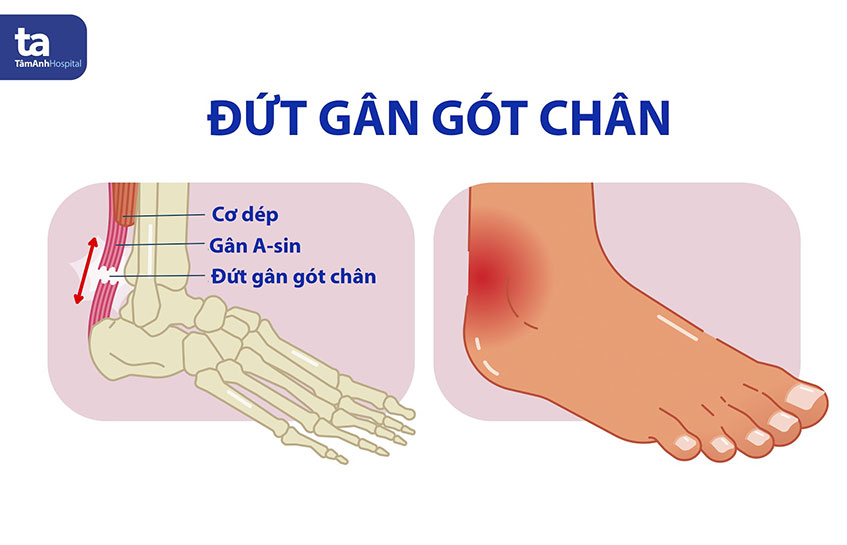 PHẪU THUẬT THÀNH CÔNG ĐỨT GÂN GÓT CHÂN ACHILLES